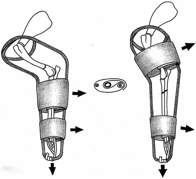 Principles of fracture fixation techniques