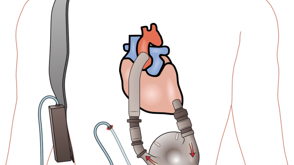 What ems needs to know about ventricular assist devices vads