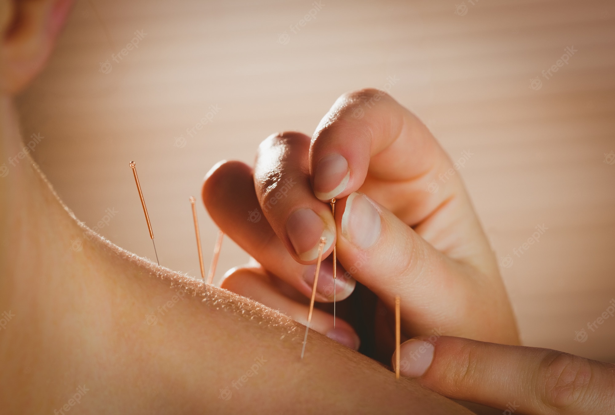 Acupuncture (traditional Chinese medicine)