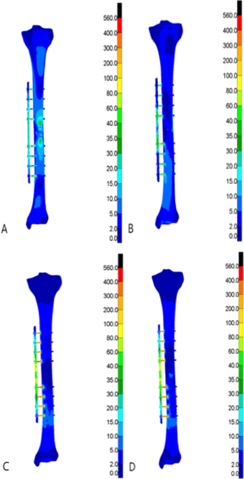 Finite element analysis parison of type a fracture fixed with external titanium alloy locking plate and traditional external fixation frame journal of orthopaedic surgery and research full text