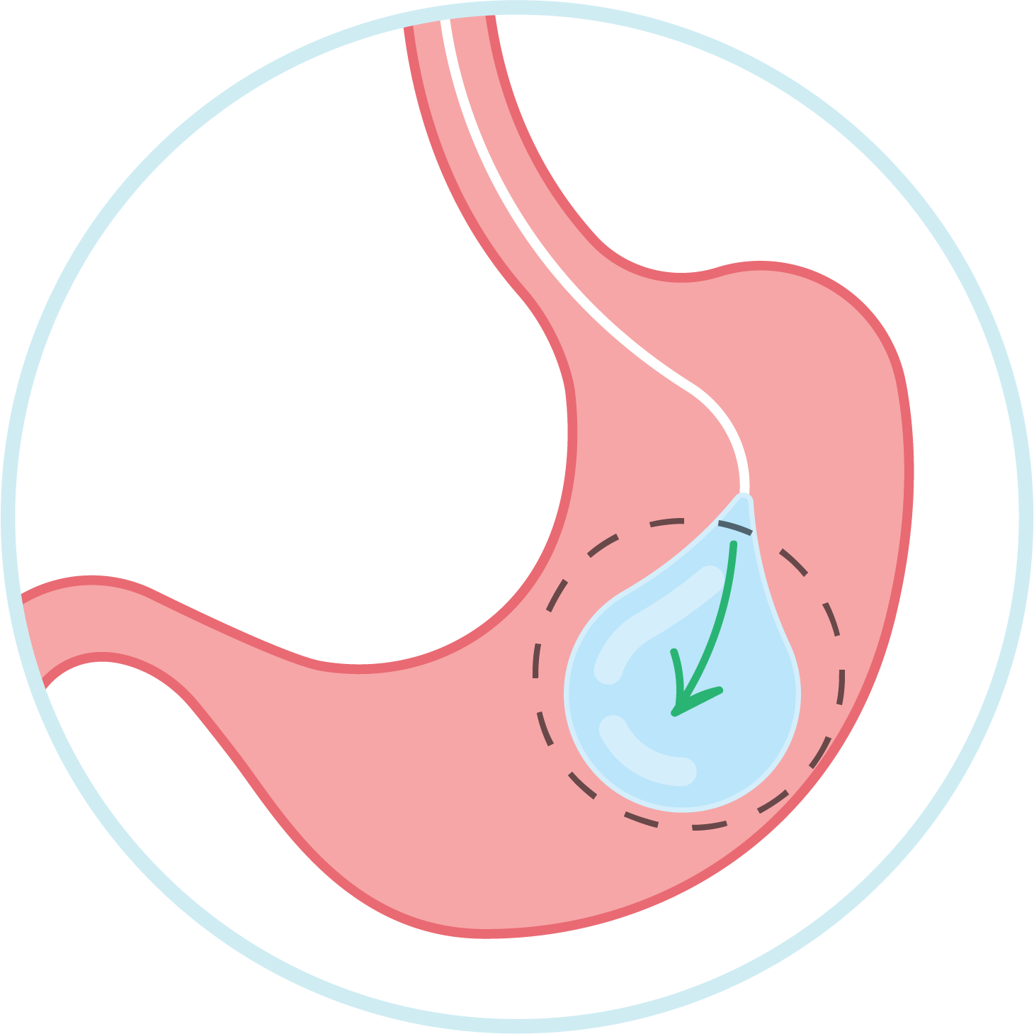 Gastric balloon