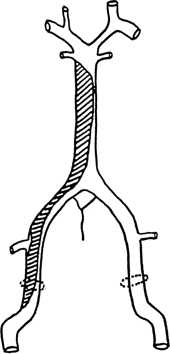 Intracranial vertebral arteries and the proximal intracranial territory chapter