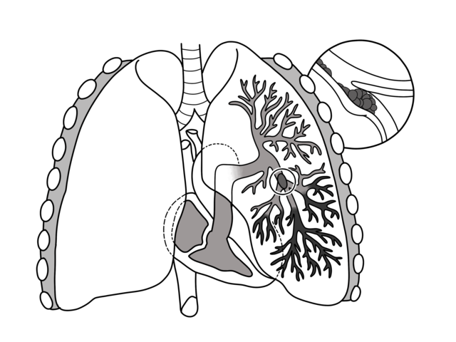 Pulmonary embolism