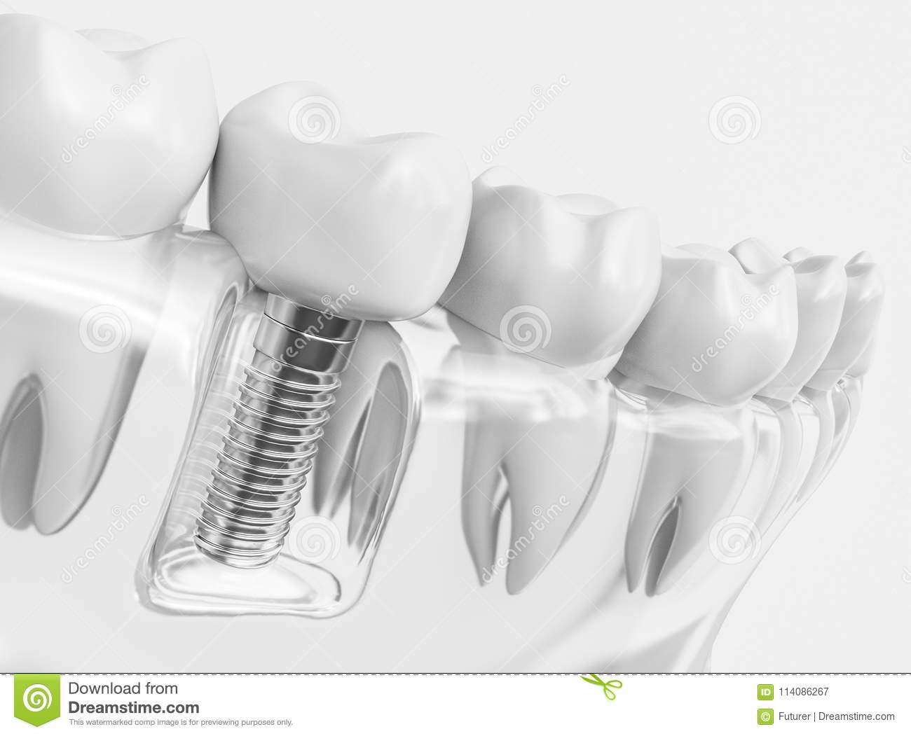 Download Free 100 + dental implant wallpapers