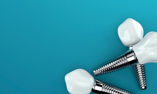 Download Free 100 + dental implant wallpapers