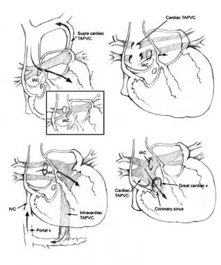 Total anomalous pulmonary venous connection background pathophysiology etiology