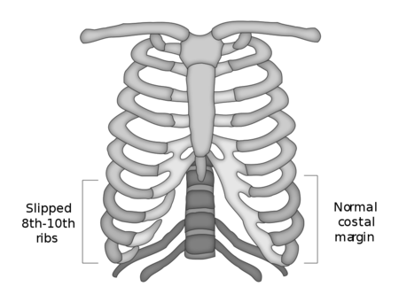 Slipping rib syndrome