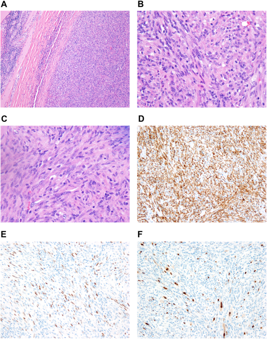 Histiocyte