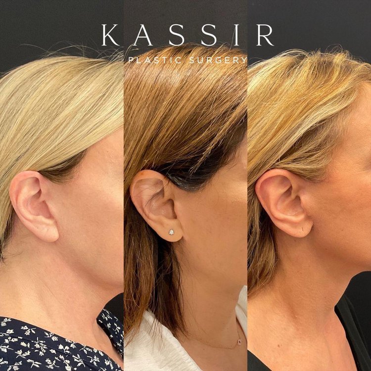 How to treat facelift scars â kassir plastic surgery in ny and nj