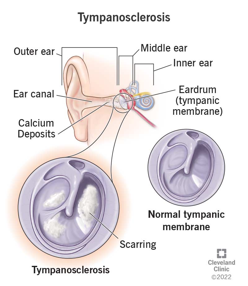 Tympanosclerosis causes symptoms treatment