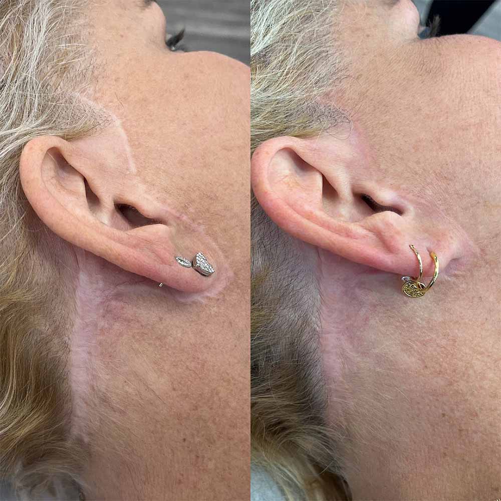 Scar camouflage with micropigmentation