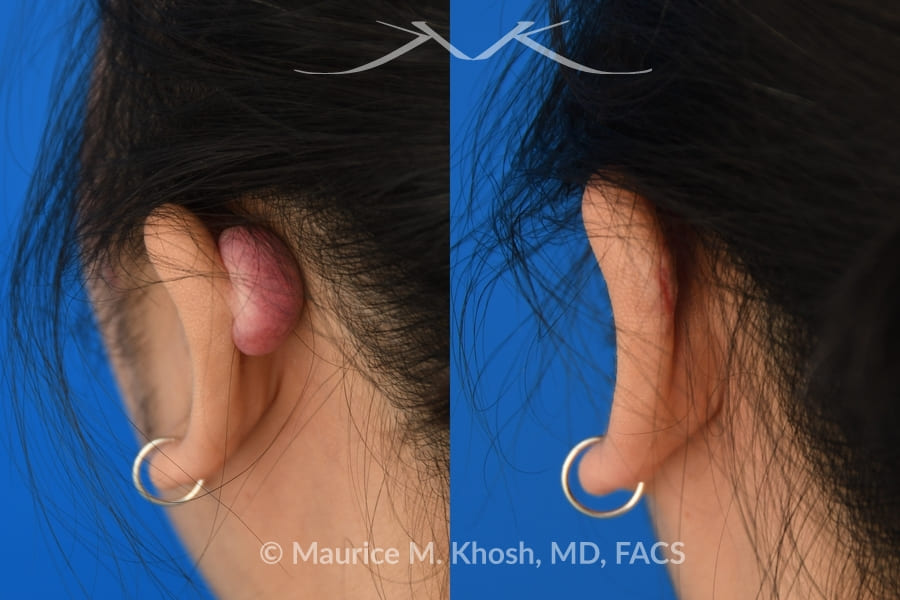 Ð new york facial plastic surgery keloid scar reconstruction before and after pictures