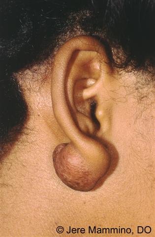 Keloids and hypertrophic scars