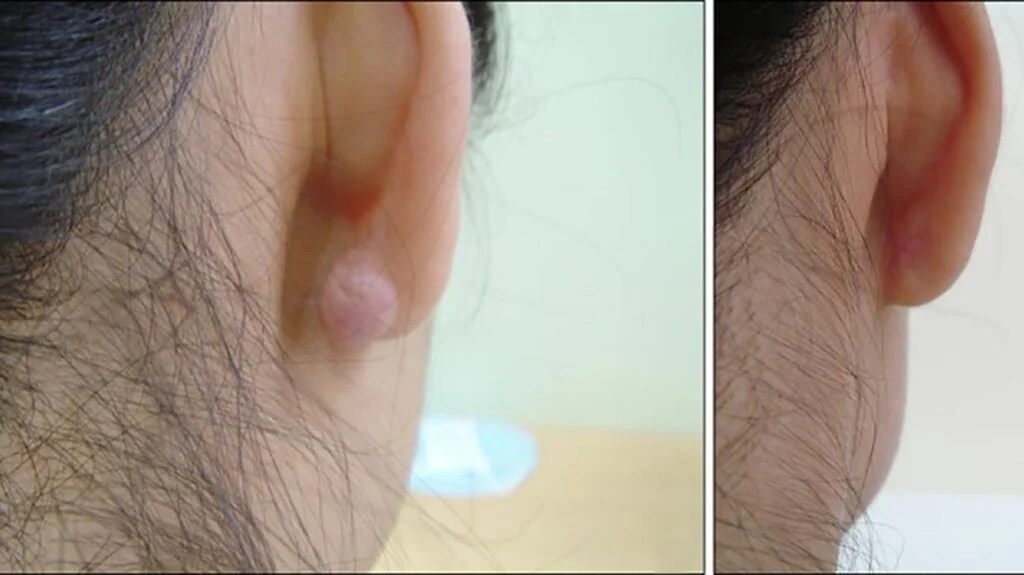 Keloid on ear causes treatment and prevention