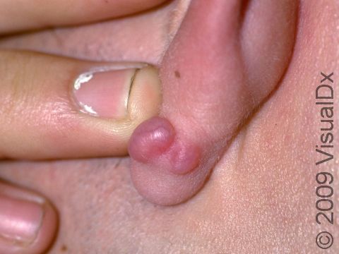 Keloid condition treatments and pictures for children
