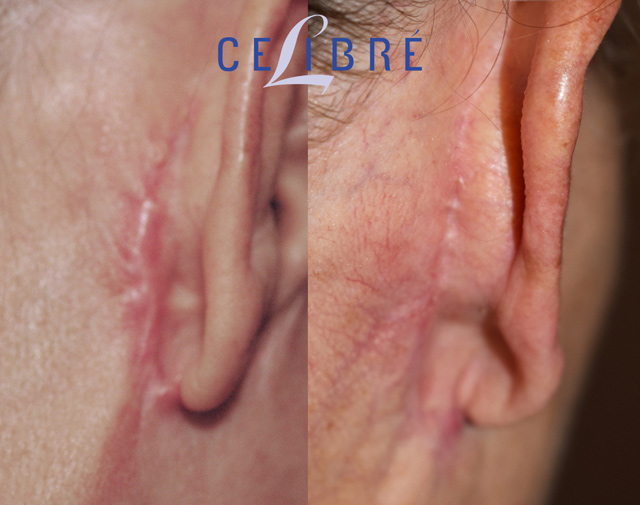 Scar removal before and after pictures