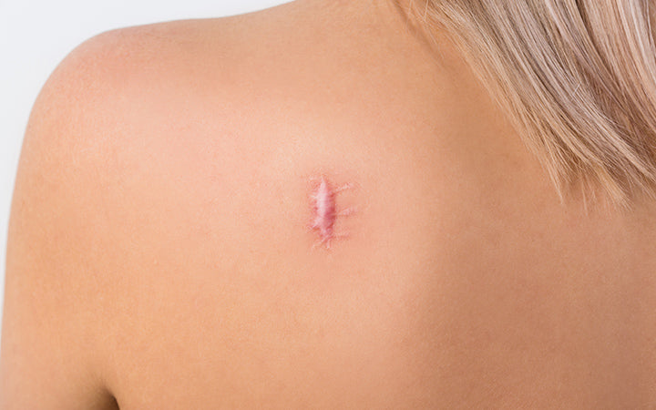 Ways to treat your keloid scars â