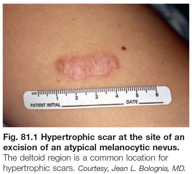 Dermal hypertrophies chapter