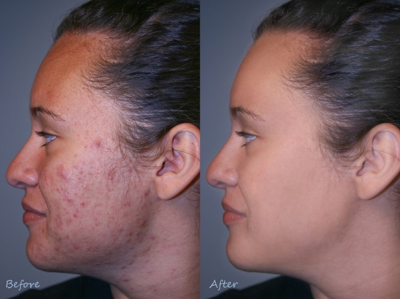 Does laser treatment work for acne scars carolina medical associates