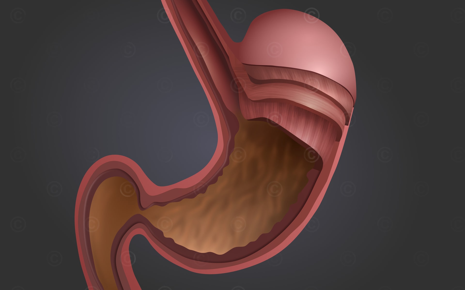 The Reflux “Cycle of Hell”: An ENT Perspective on Setting Patients Free -  UCSF MedConnection