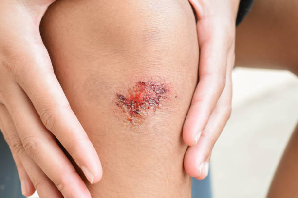 Skin wound stock photos pictures royalty