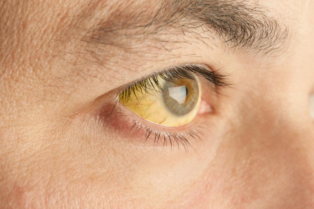 Yellow Skin (Jaundice): Pictures, Symptoms, Causes, and Diagnosis